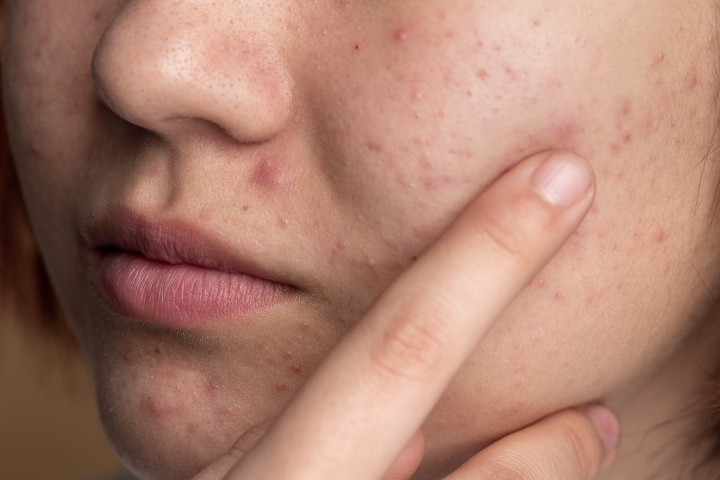 https://staging.healthychoicenepal.com/wp-content/uploads/2023/04/close-up-skin-acne.jpg