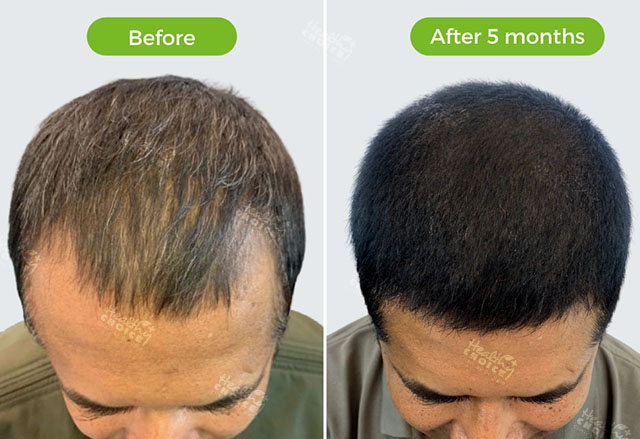 https://staging.healthychoicenepal.com/wp-content/uploads/2023/05/1500graft.jpg