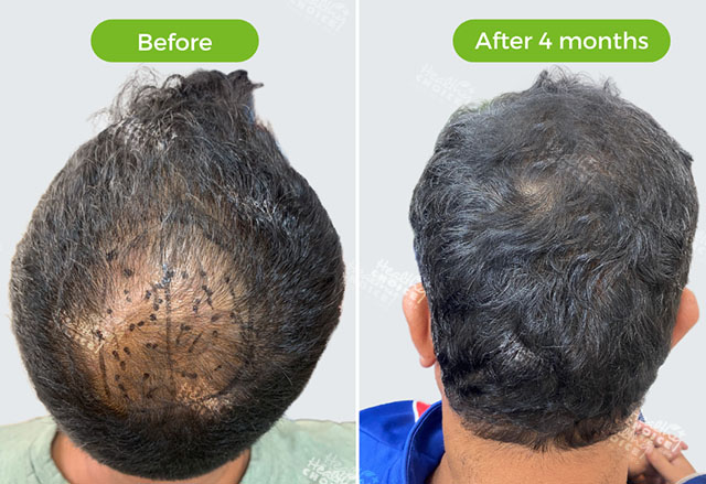 https://staging.healthychoicenepal.com/wp-content/uploads/2023/05/2500graft.jpg
