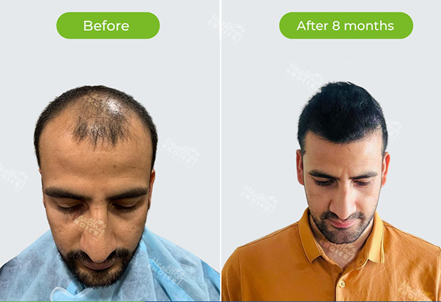 https://staging.healthychoicenepal.com/wp-content/uploads/2023/05/3500graft.jpg