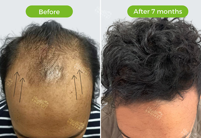 https://staging.healthychoicenepal.com/wp-content/uploads/2023/05/4000graft.jpg