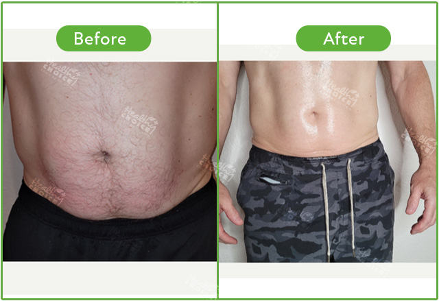 https://staging.healthychoicenepal.com/wp-content/uploads/2023/05/Cryolipolysis-4.jpg