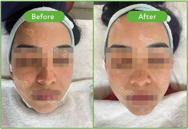 https://staging.healthychoicenepal.com/wp-content/uploads/2023/05/Hydrafacia-2.jpg