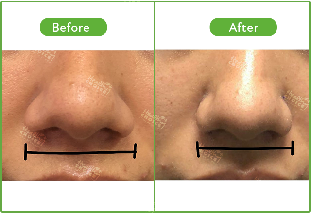 Alar Base Reduction Rhinoplasty