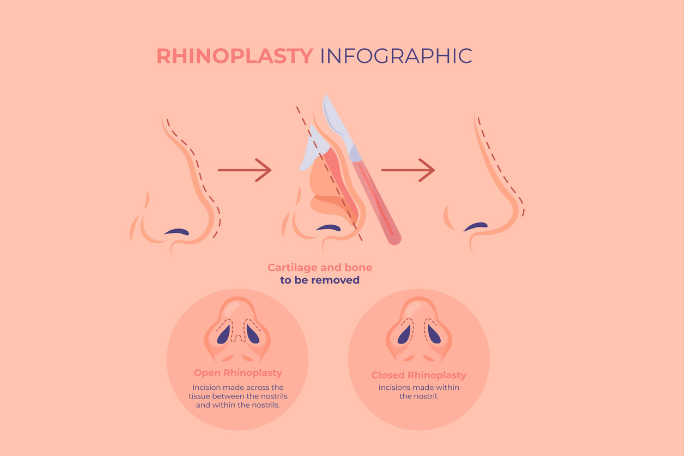 https://staging.healthychoicenepal.com/wp-content/uploads/2023/05/Rhinoplasty2.png