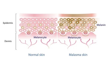 https://staging.healthychoicenepal.com/wp-content/uploads/2023/05/normal-skin-layer-melasma-vector-260nw-2133311457.jpg