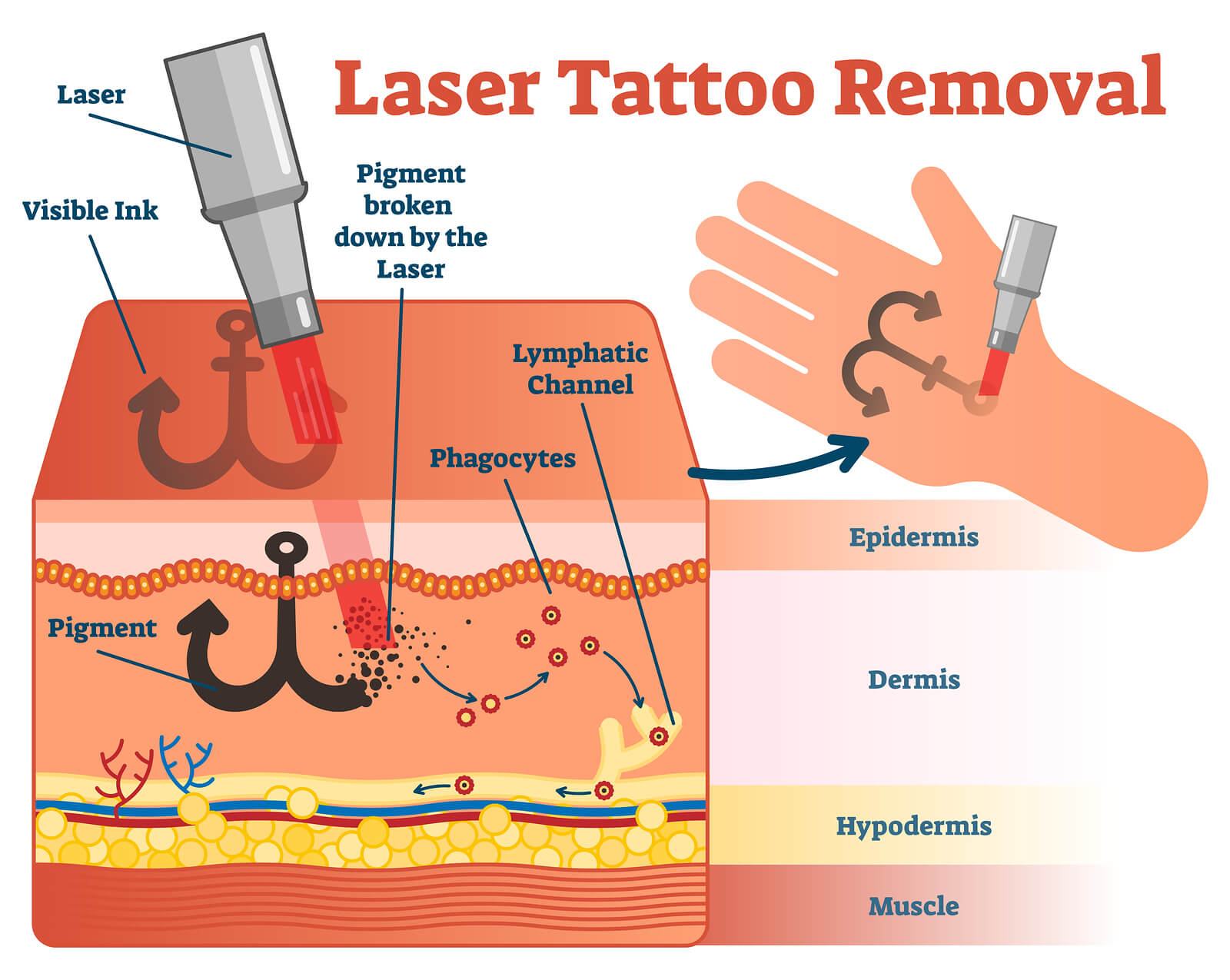 https://staging.healthychoicenepal.com/wp-content/uploads/2023/05/tattoo-removal-anatomy.jpg