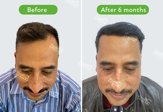 https://staging.healthychoicenepal.com/wp-content/uploads/2023/06/2000graft_Manojit-Kunwar.jpg