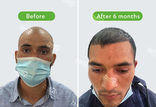 https://staging.healthychoicenepal.com/wp-content/uploads/2023/06/2631graft_prem-bikash-bk.jpg