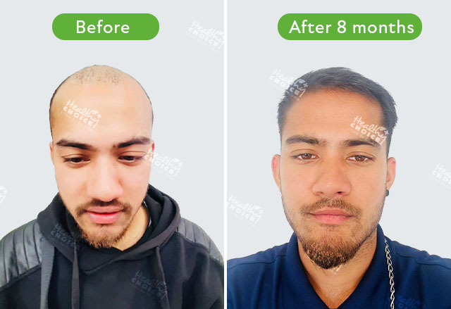 https://staging.healthychoicenepal.com/wp-content/uploads/2023/06/4065graft_Kasim-Hussain.jpg