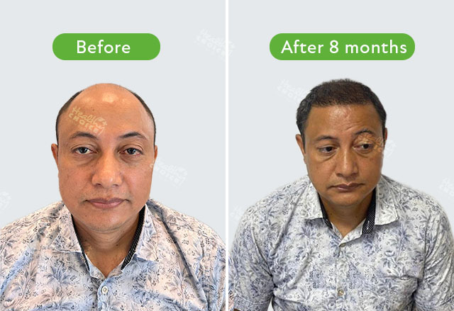 https://staging.healthychoicenepal.com/wp-content/uploads/2023/06/Chiranjeevi-Acharya_5000-graft_Before-8-months.jpg