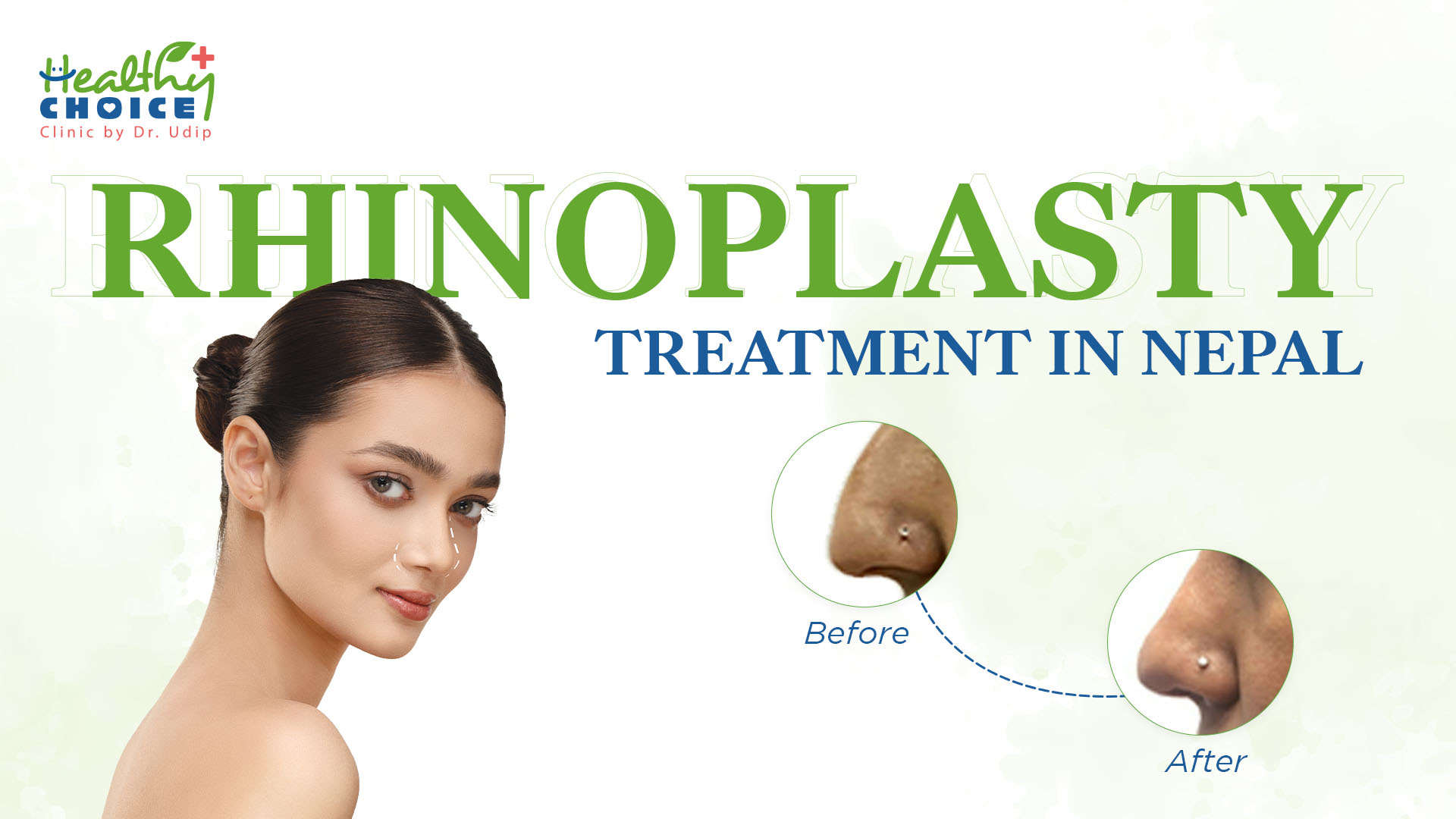 https://staging.healthychoicenepal.com/wp-content/uploads/2023/06/best-rhinoplasty-treatment-in-kathmandu-nepal.jpg