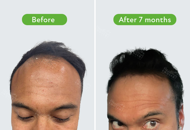https://staging.healthychoicenepal.com/wp-content/uploads/2023/07/Hikmat-shrestha-3500-graft-7-month.jpg