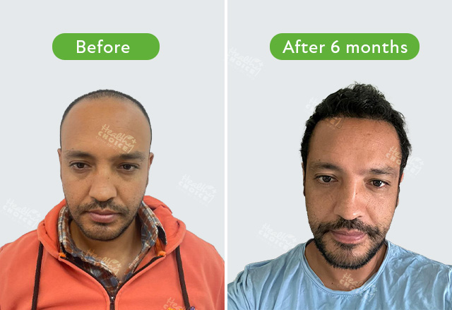 https://staging.healthychoicenepal.com/wp-content/uploads/2023/07/Niranjan-Humagain-3500-graft.jpg