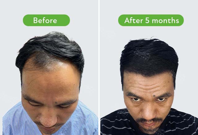 https://staging.healthychoicenepal.com/wp-content/uploads/2023/08/Hem-Limbu-3578-graft-before-5-month.jpg