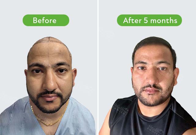 https://staging.healthychoicenepal.com/wp-content/uploads/2023/08/Hem-adhikari-4711-graft-after-6-month-completed.jpg