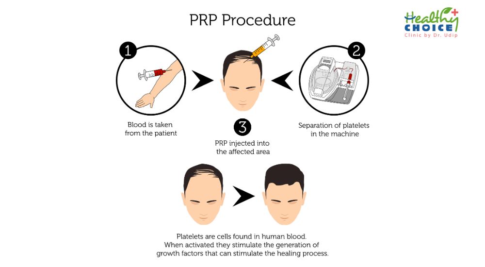 https://staging.healthychoicenepal.com/wp-content/uploads/2023/08/PRP-best-hair-restoration-in-nepal-technique-healthy-choice-clinic.jpg