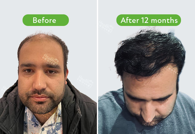 https://staging.healthychoicenepal.com/wp-content/uploads/2023/08/Sanjay-Adhikari-5300-graft.jpg