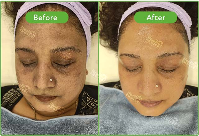 HydraFacial result at Healthy Choice Clinic