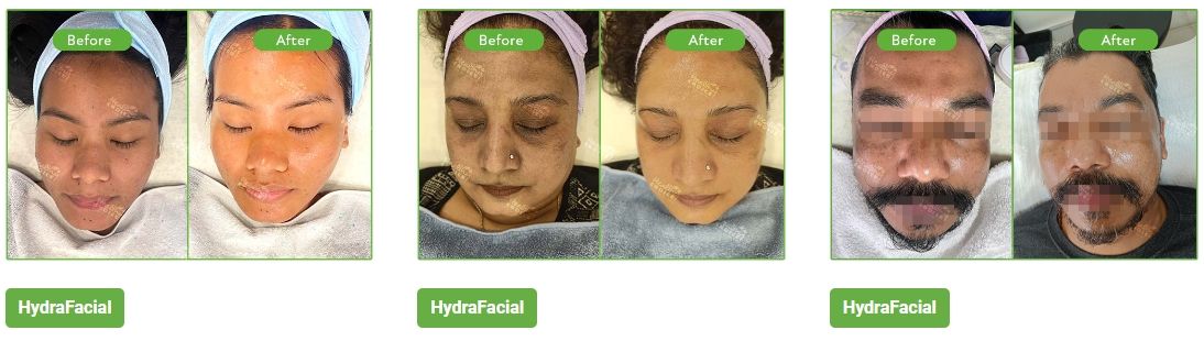best hydrafacial in kathmandu