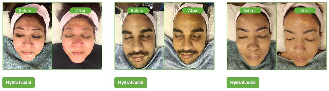 best hydrafacial in nepal