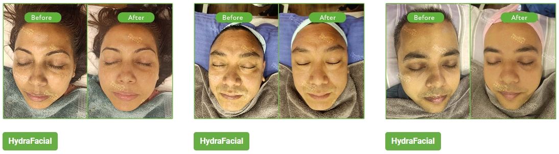 best hydrafacial price in nepal