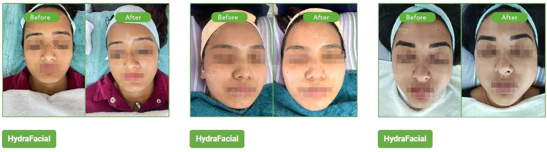 best hydrafacial result in kathmandu nepal