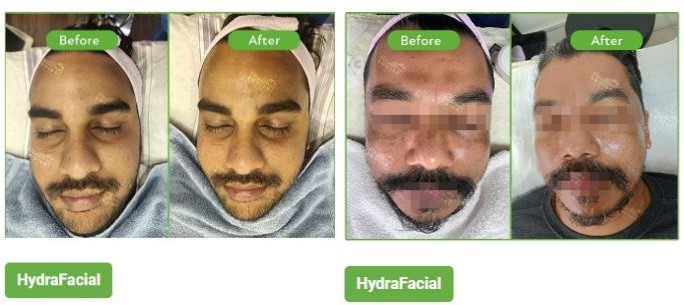 hydrafacial-in-kathmandu-nepal