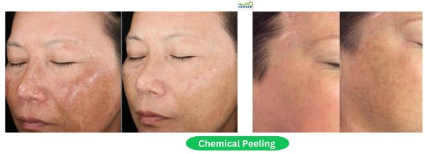 Chemical Peeling Price in NEpal