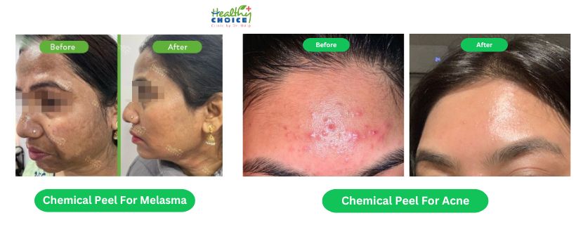 chemical peel price in nepal