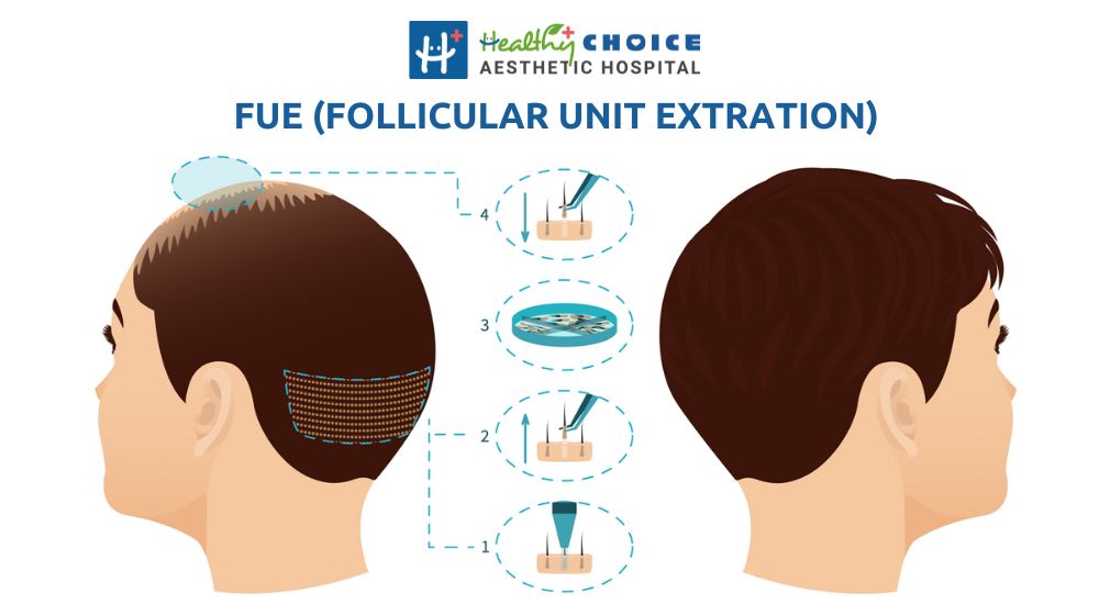 best hair transplant in nepal fue follicular unit extraction hair transplantation