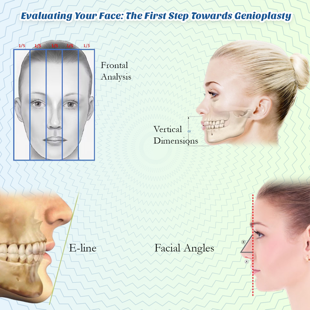 Genioplasty 1 copy (5) Evaluating Your Face: The First Step Towards Genioplasty