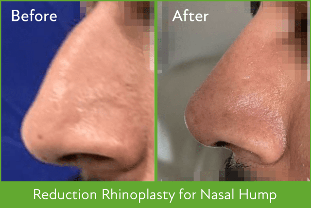 Nose surgery in Kathmandu - Rhinoplasty for Men - Rhinoplasty in Nepal - Best rhinoplasty hospital in Nepal