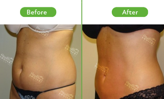 Image: Tummy Tuck Before and After