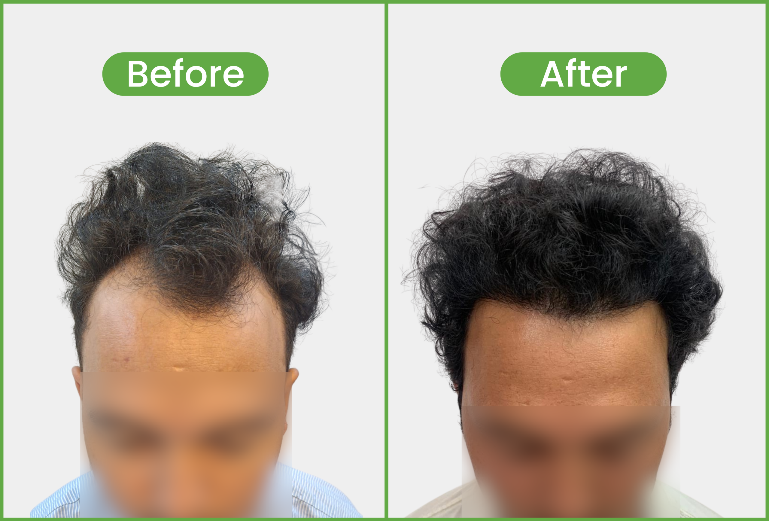 https://staging.healthychoicenepal.com/wp-content/uploads/2025/06/2200-graft-scaled.png