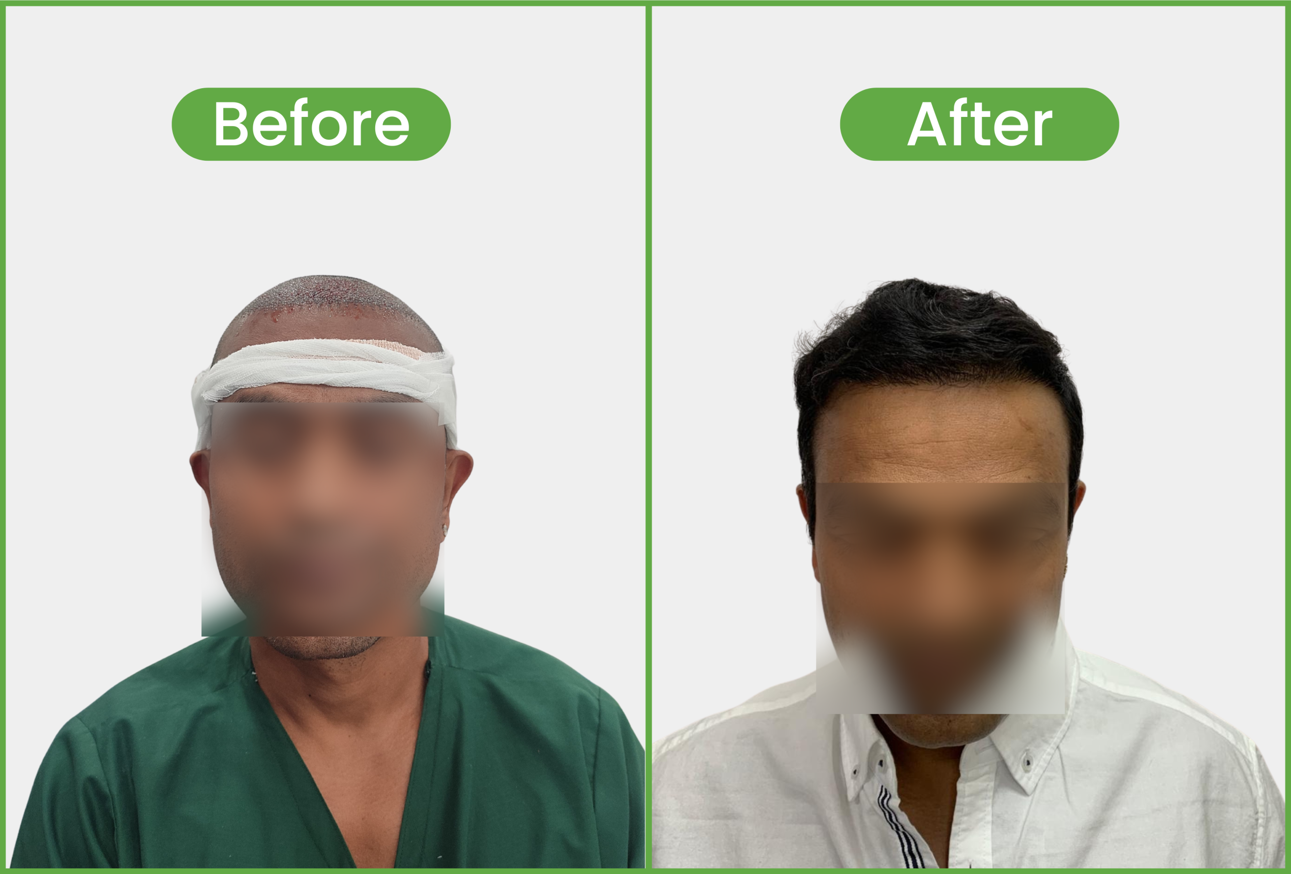 hair transplant success stories in nepal - 2600 Grafts