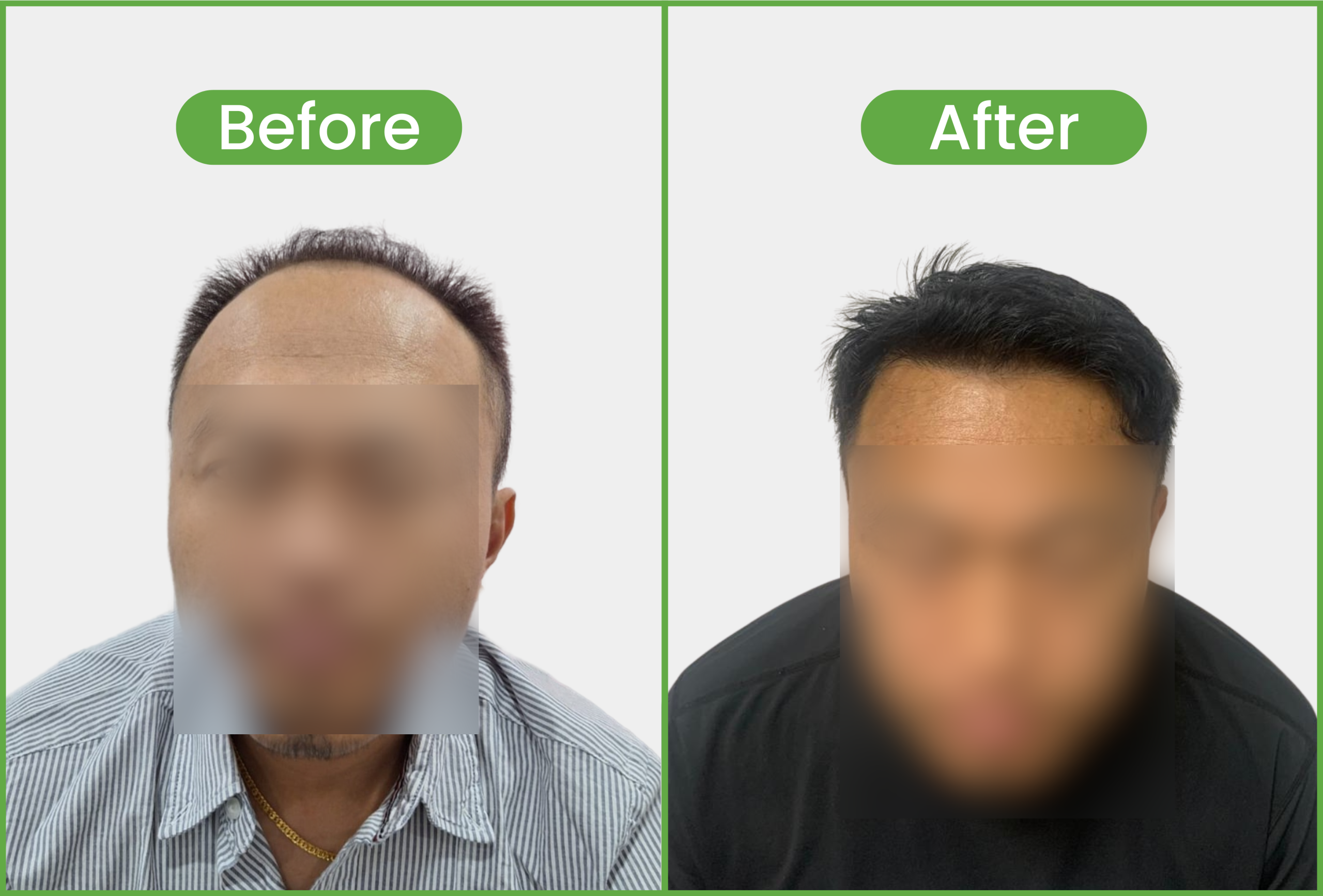 hair transplant success stories in nepal - 3059 Grafts