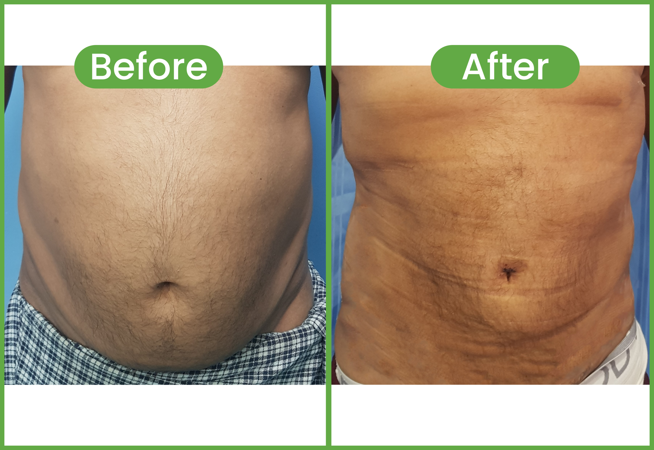 liposuction before and after pictures - best liposuction surgery in nepal - top liposuction surgery hospital in nepal - Healthy Choice Aesthetic Hospital