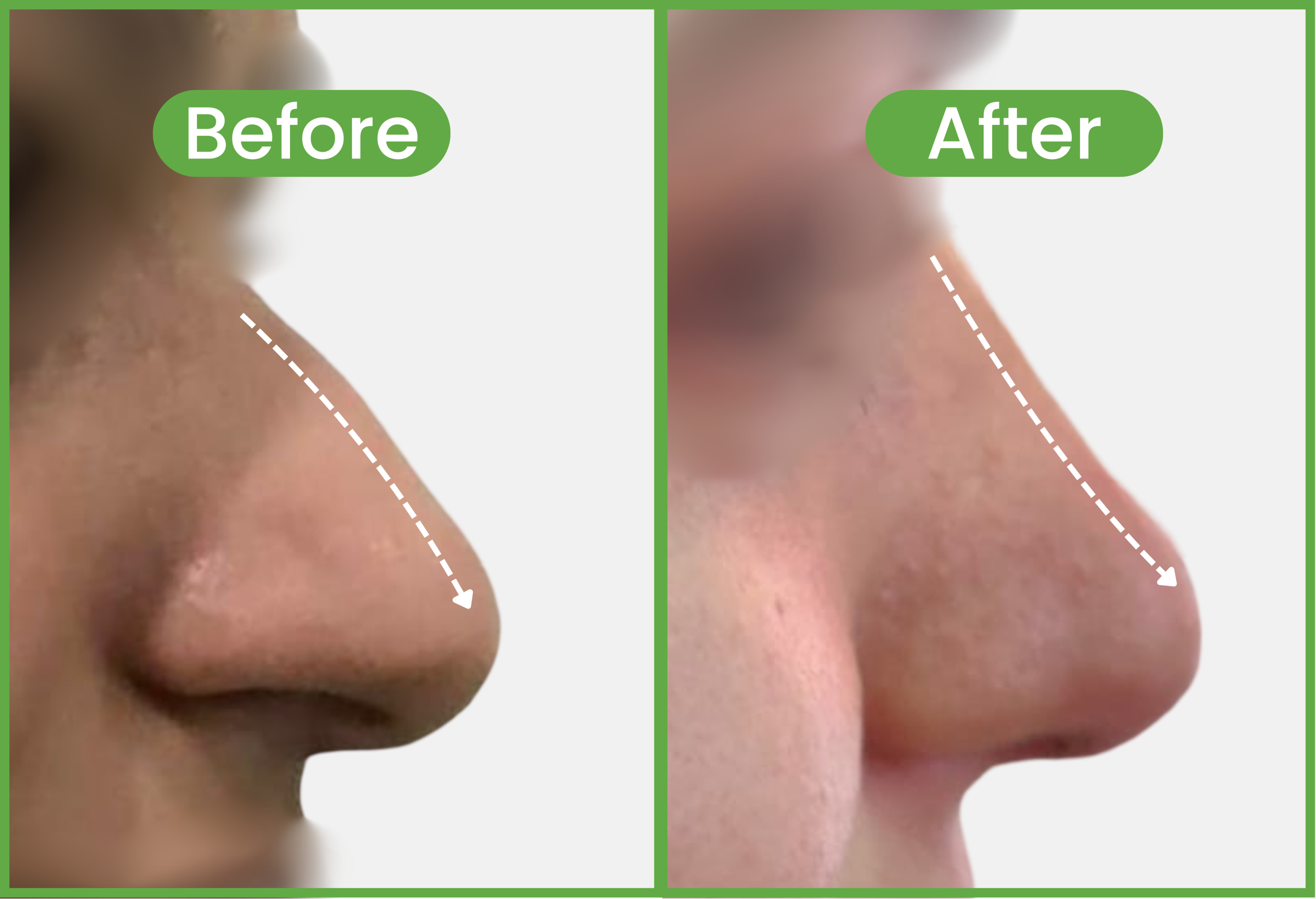 Rhinoplasty before and after near me - Overprojected Nose Correction