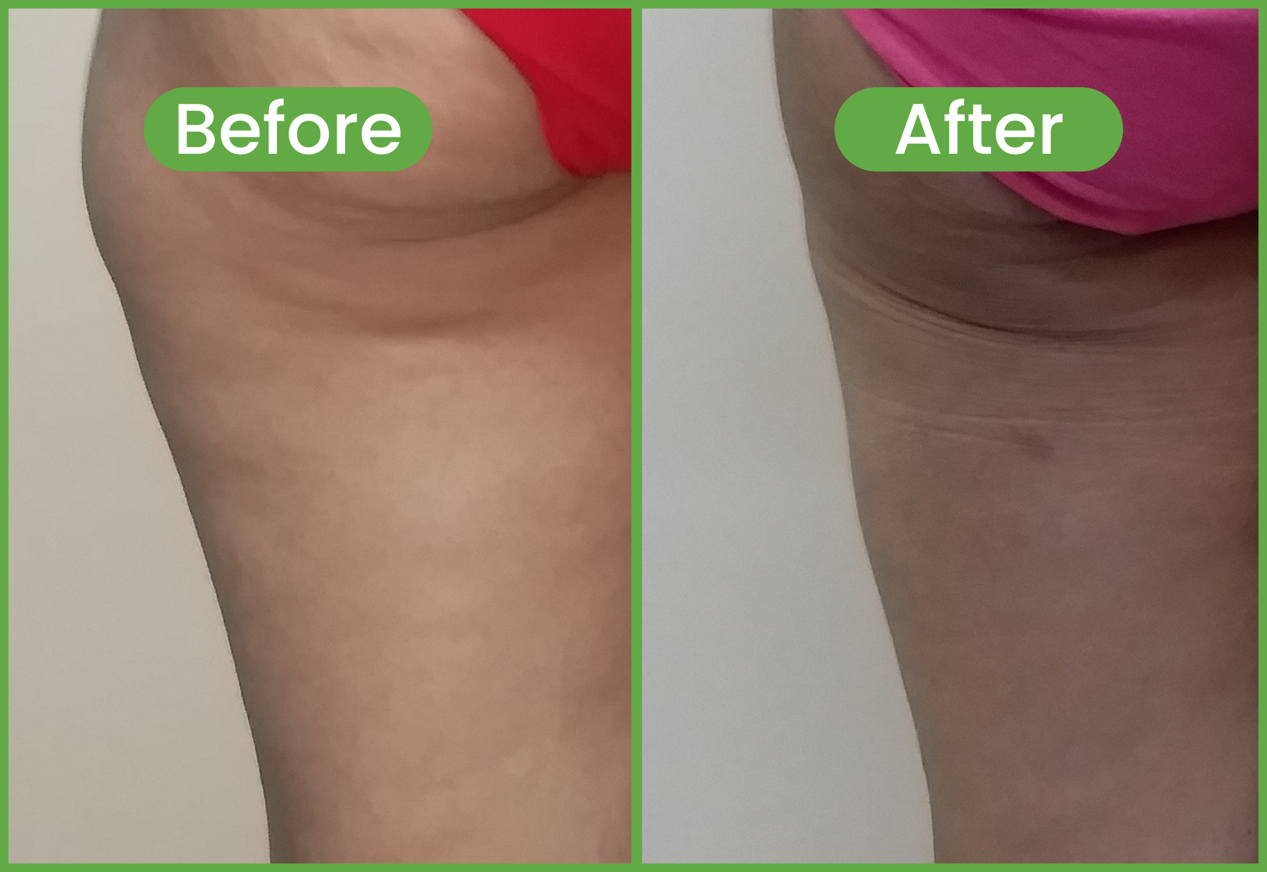 top liposuction surgery hospital in nepal - liposuction before and after pictures - best liposuction surgery in nepal - Healthy Choice Aesthetic Hospital