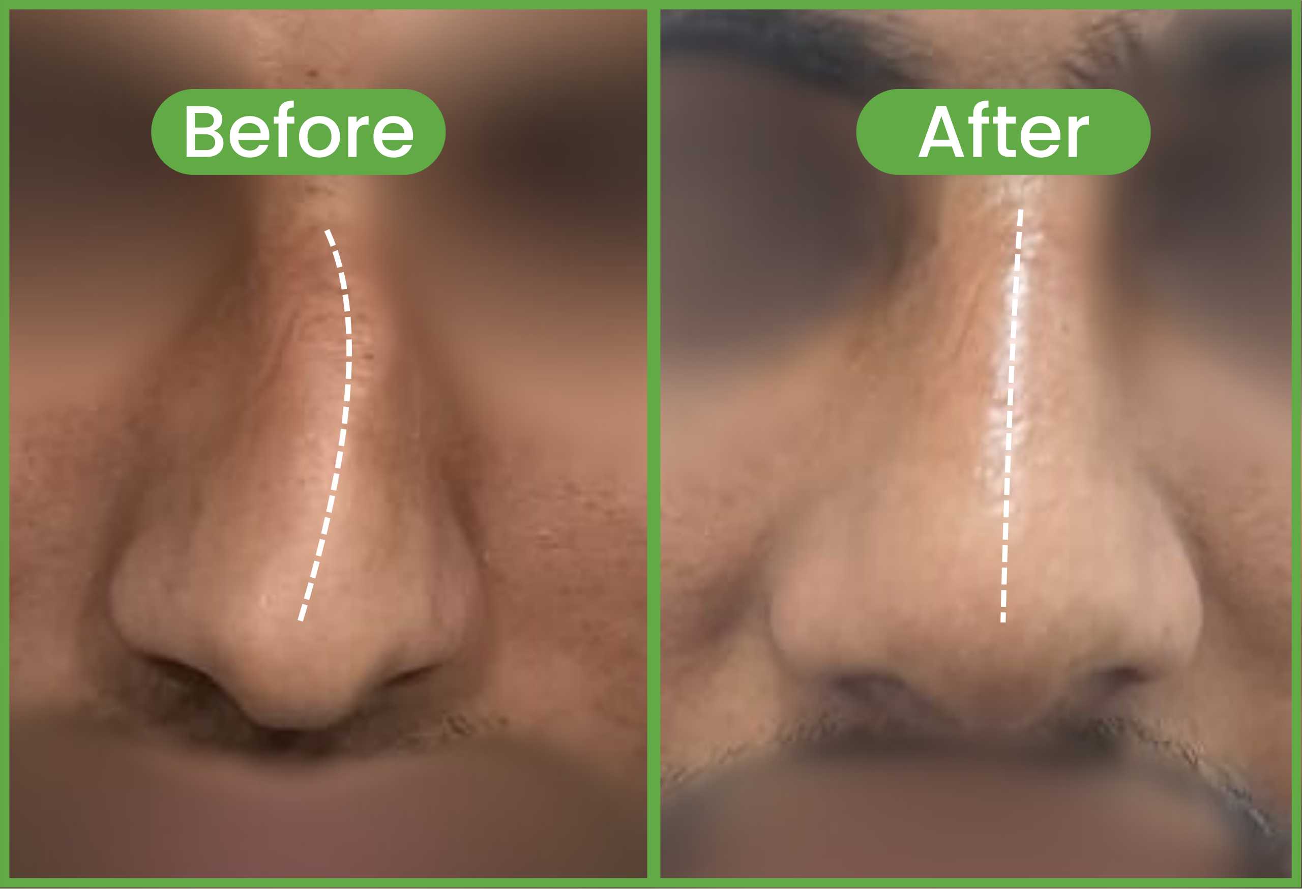 Rhinoplasty before and after near me - Crooked Nose Correction