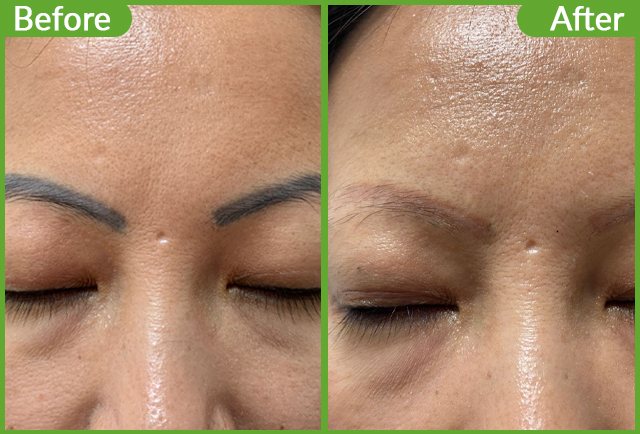 https://staging.healthychoicenepal.com/wp-content/uploads/2025/10/Tato-removal-copy.jpg