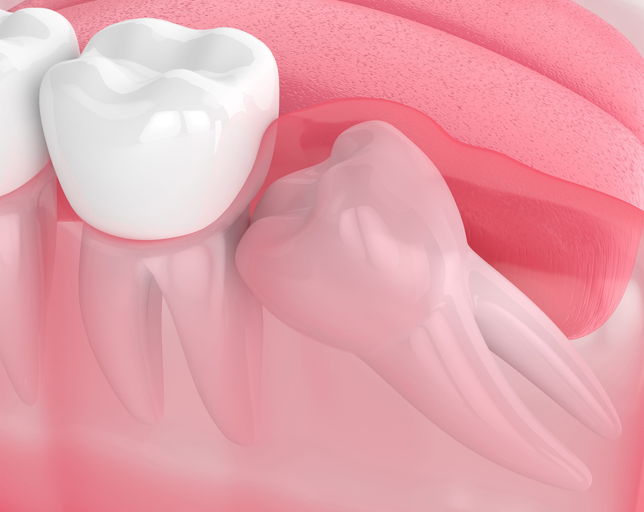 https://staging.healthychoicenepal.com/wp-content/uploads/2025/11/Causes-of-Tooth-Impaction-copy-1.jpg